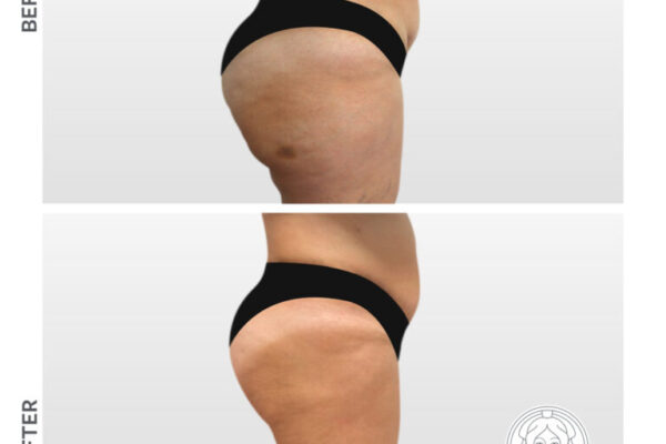 La Liposuzione: Procedura, Vantaggi e Rischi