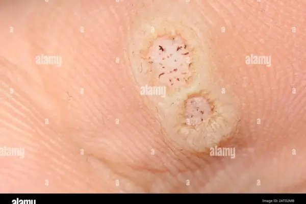 papilloma virus — IT news